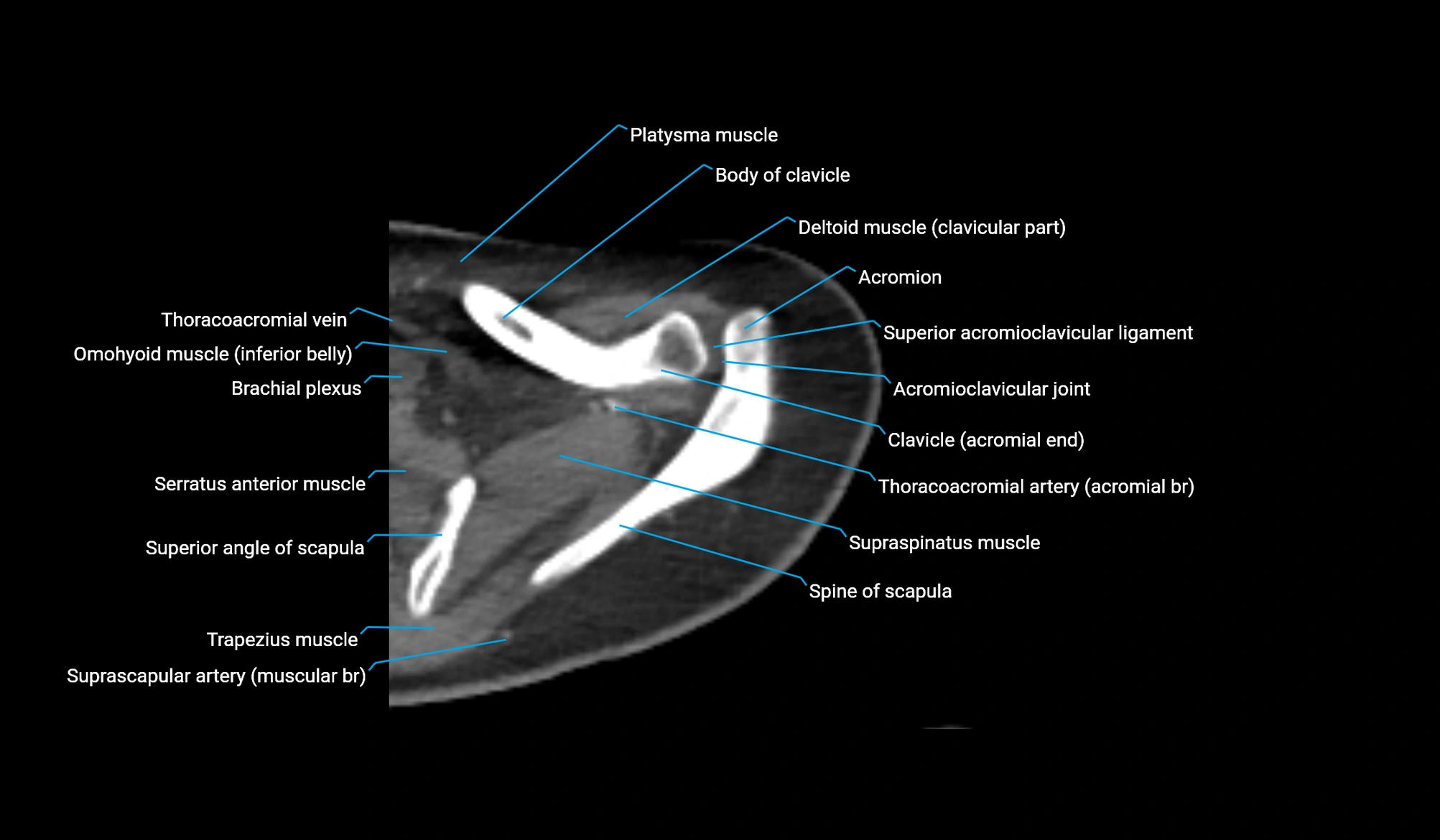 CT upper arm axial  cross sectional anatomy labelled radiology image -00062.webp